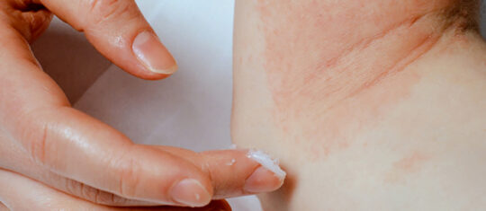 psoriasis